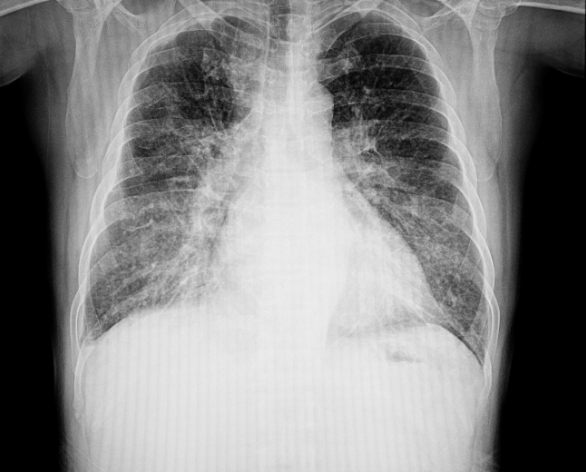 Παθήσεις του μεσοθωράκιου